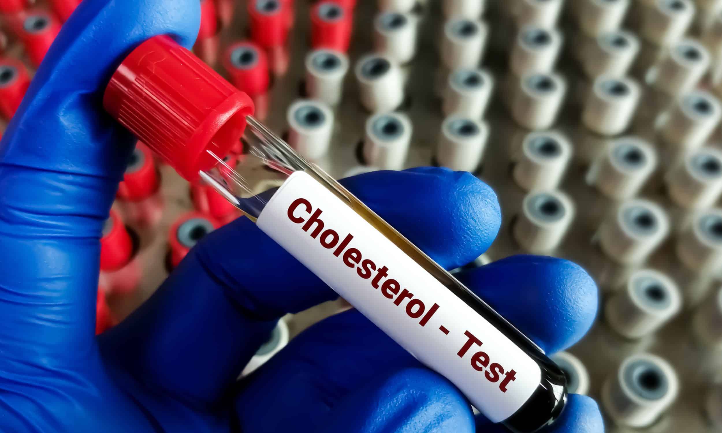 cholesterol test tube full of blood