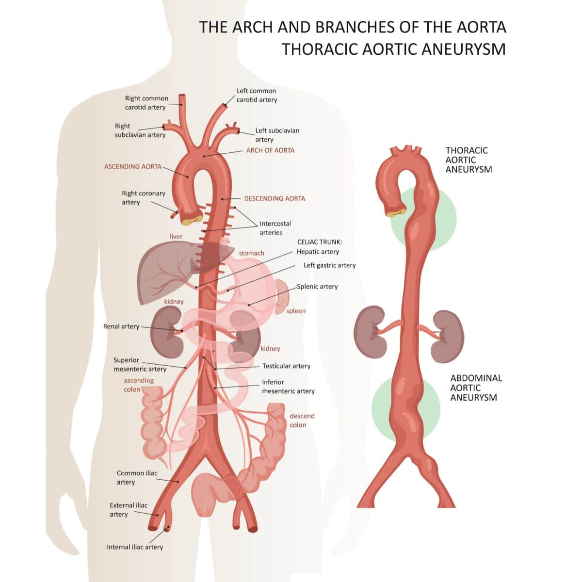 graphic showing what a Aortic Aneurysm looks like