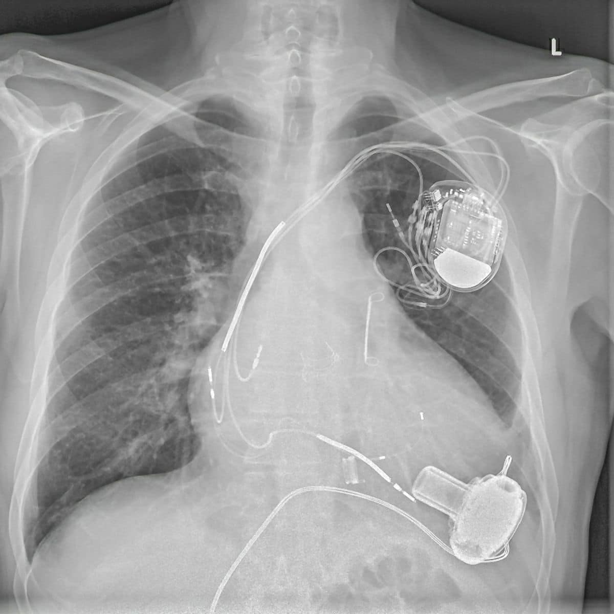 x-ray showing a Left Ventricular Assist Device (LVAD)