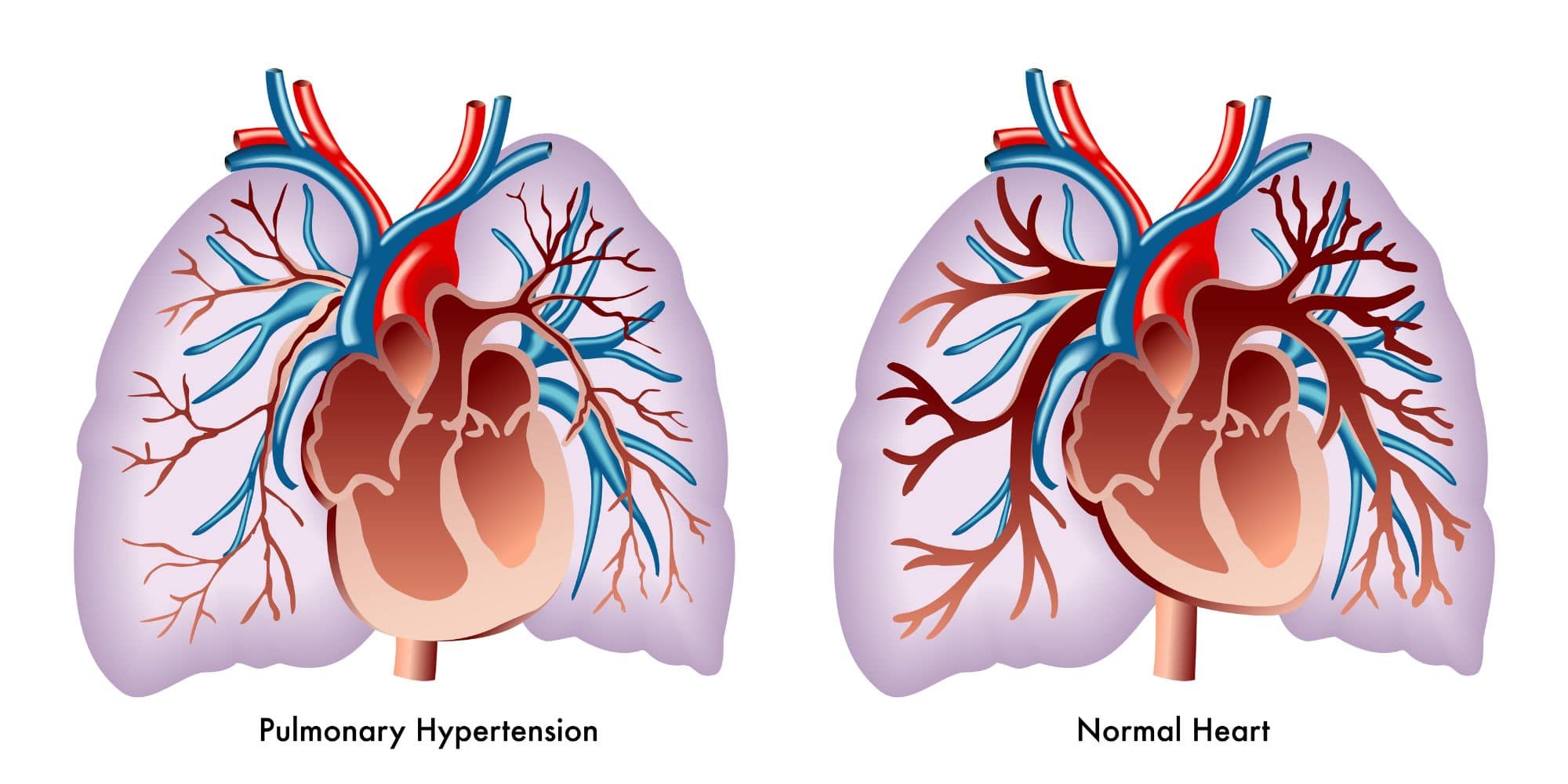 graphic of a healthy human heart vs a heart with Pulmonary Hypertension