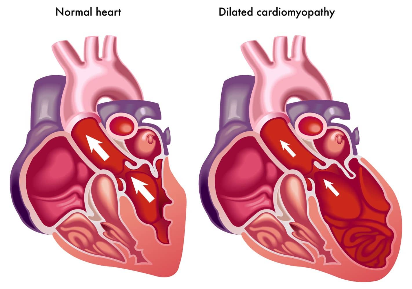 graphic of a normal healthy heart vs an unhealthy heart due to Dilated Cardiomyopathy
